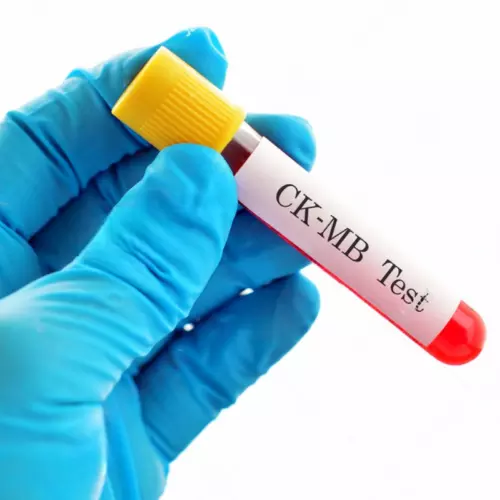 CKMB Test, Best Test for Heart Damage, Cost of CKMB Test, NABL Certified Maurya Labs