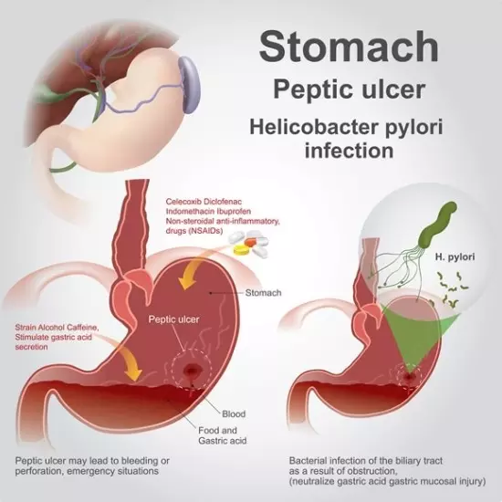peptic ulcer caused by h pylori virus